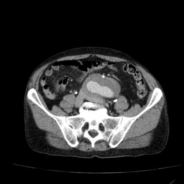File:Abdominal aortic aneurysm (Radiopaedia 29248-29660 Axial C+ portal venous phase 44).jpg