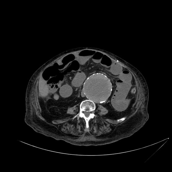 File:Abdominal aortic aneurysm - impending rupture (Radiopaedia 19233-19246 Axial non-contrast 74).jpg