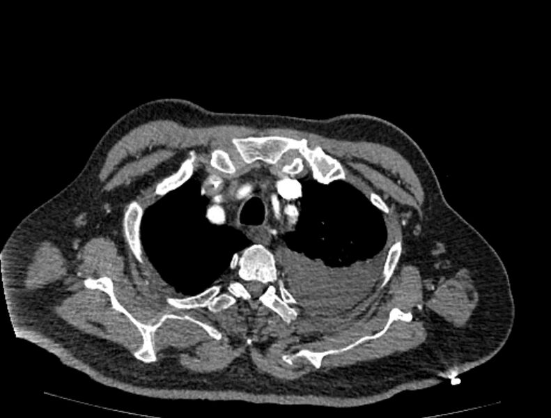 File:Abdominal aortic aneurysm rupture (Radiopaedia 54179-60362 Axial C+ arterial phase 2).jpg