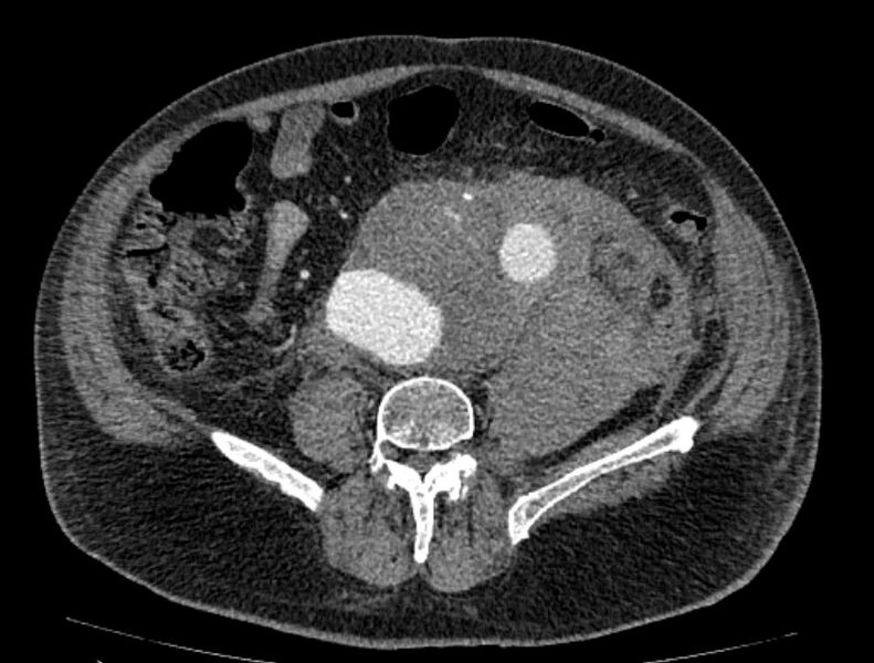 File:Abdominal aortic aneurysm rupture (Radiopaedia 54179-60362 Axial C+ portal venous phase 14).jpg