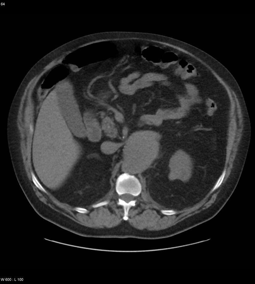 Abdominal aortic aneurysm with intramural hematoma then rupture (Radiopaedia 50278-55631 Axial non-contrast 60).jpg