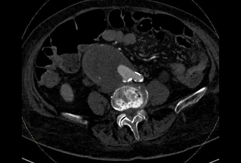 File:Abdominal aortic aneurysm with thrombus fissuration (Radiopaedia 73192-83919 Axial C+ arterial phase 133).jpg