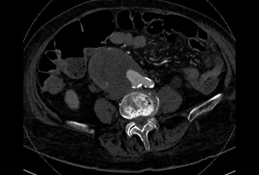 Abdominal aortic aneurysm with thrombus fissuration (Radiopaedia 73192-83919 Axial C+ arterial phase 133).jpg