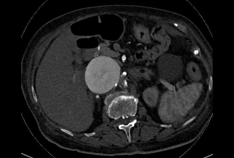 File:Abdominal aortic aneurysm with thrombus fissuration (Radiopaedia 73192-83919 Axial C+ arterial phase 45).jpg
