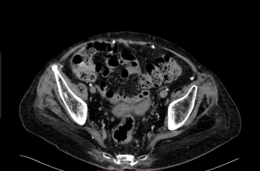 Abdominal aortic interposition tube graft and aneurysm thrombosis (Radiopaedia 71438-81857 Axial C+ arterial phase 197).jpg
