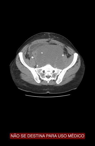 File:Abdominal desmoid tumor (Radiopaedia 44024-47540 Axial C+ arterial phase 33).jpg