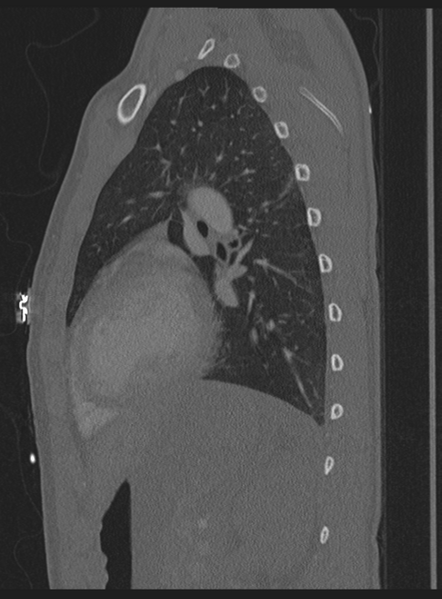 File:Abdominal multi-trauma - devascularised kidney and liver, spleen and pancreatic lacerations (Radiopaedia 34984-36486 Sagittal bone window 8).png