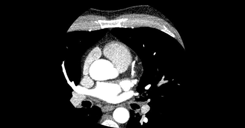 File:Aberrant left main coronary artery (ALMCA) arising from the right sinus with interarterial course (Radiopaedia 63251-71814 Axial C+ arterial phase 52).JPG