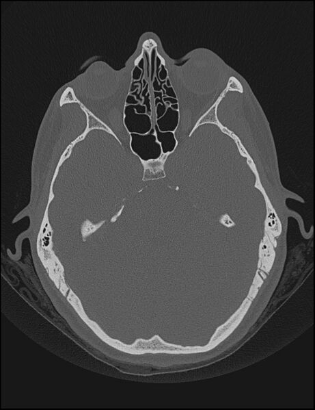 File:Aberrant right internal carotid artery (Radiopaedia 65191-74198 Axial non-contrast 60).jpg