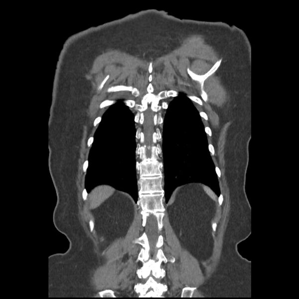 File:Aberrant right subclavian and left vertebral arteries (Radiopaedia 43467-46847 Coronal C+ portal venous phase 73).jpg