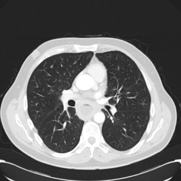 File:Achalasia (Radiopaedia 24937-25206 Axial lung window 17).jpg