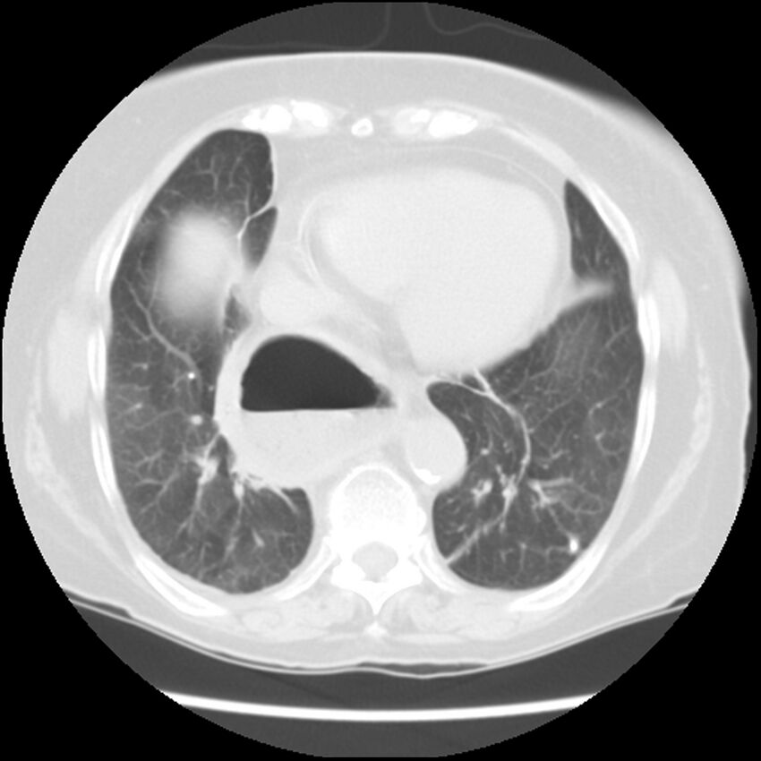 Achalasia (Radiopaedia 44094-47649 Axial lung window 42).jpg