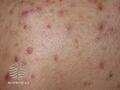 Acne affecting the back images (DermNet NZ acne-acne-back-181).jpg