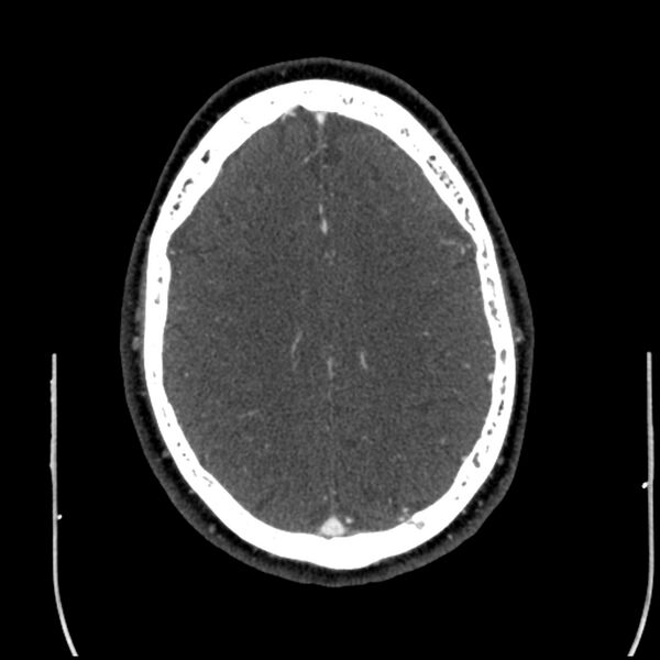 File:Acute A3 occlusion with ACA ischemic penumbra (CT perfusion) (Radiopaedia 72036-82527 Axial C+ arterial phase thins 11).jpg