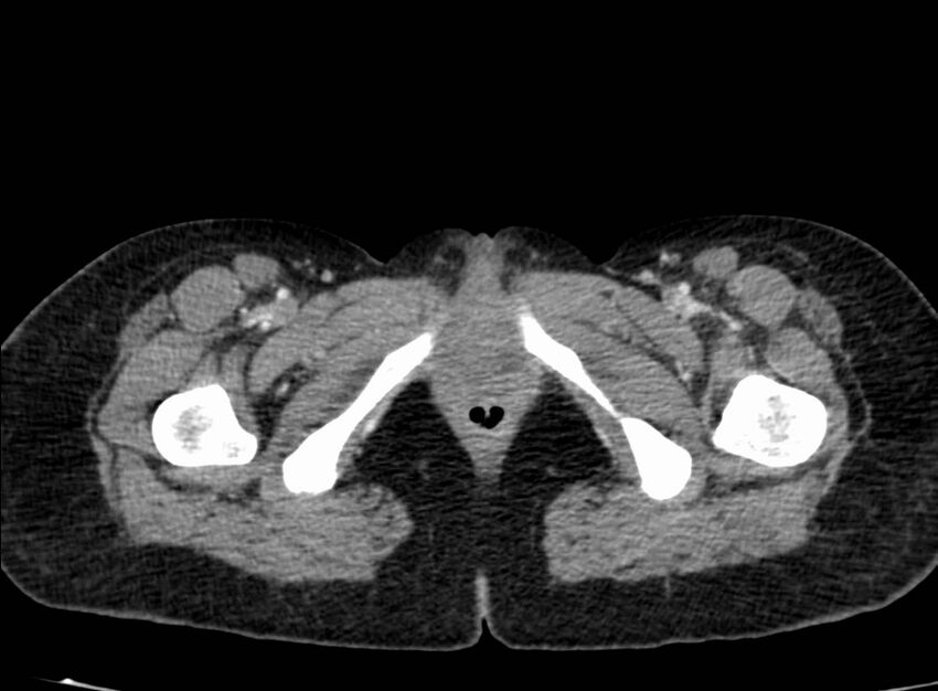Acute Budd-Chiari syndrome (Radiopaedia 60858-68638 Axial C+ portal venous phase 314).jpg