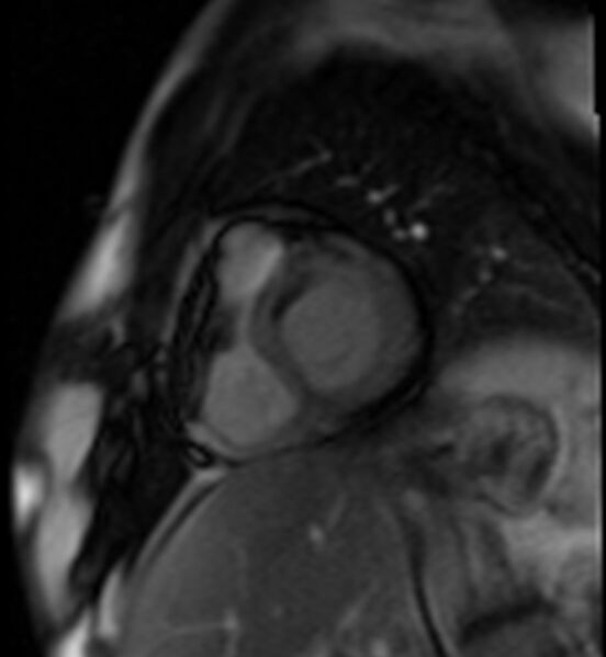 File:Acute anteroseptal myocardial infarction (Radiopaedia 68409-77945 Short axis (basal) Perfusion 21).jpg