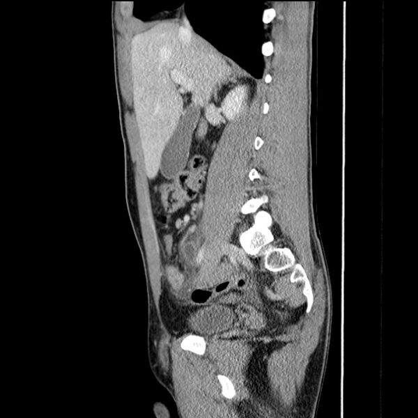 File:Acute appendicitis (Radiopaedia 27049-27227 Sagittal C+ portal venous phase 31).jpg