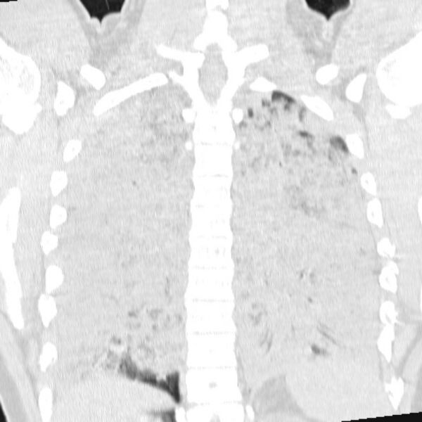 File:Acute aspiration pneumonitis (Radiopaedia 33605-34703 Coronal lung window 59).jpg