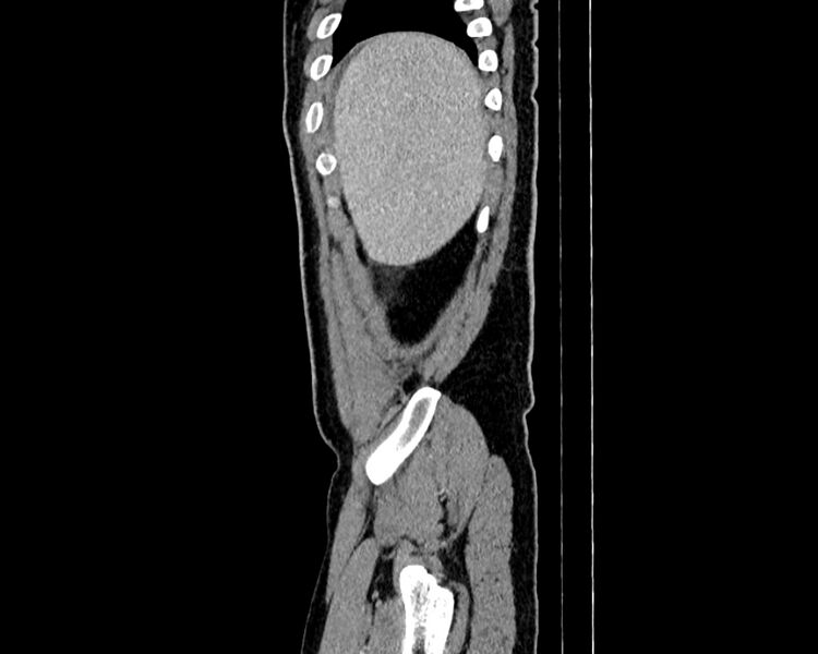 File:Acute cholecystitis (Radiopaedia 53216-59182 Sagittal C+ portal venous phase 1).jpg