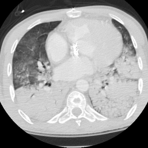 File:Acute diffuse alveolar hemorrhage (Radiopaedia 41323-44158 Axial lung window 36).jpg