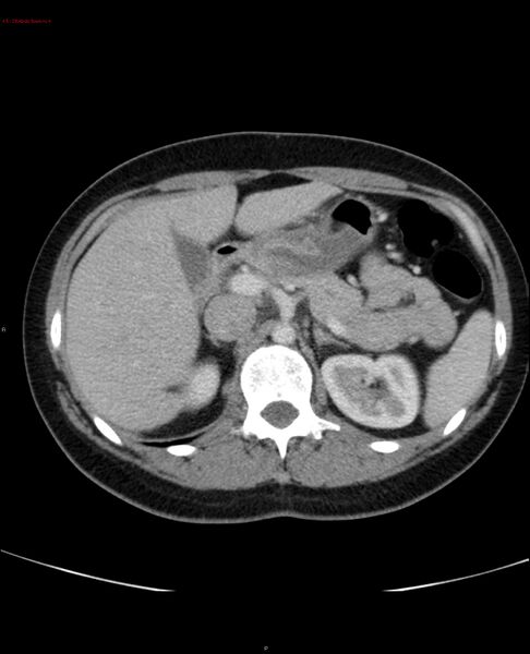 File:Acute gastritis (Radiopaedia 21043-20975 Axial C+ portal venous phase 15).jpg