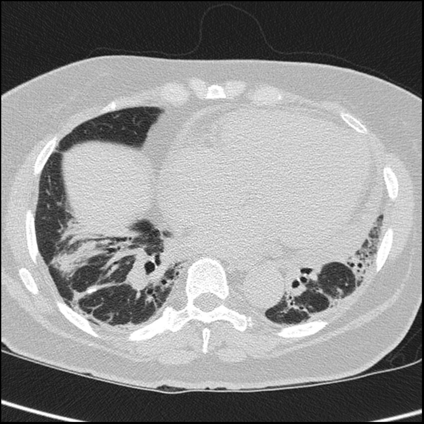 Acute interstitial pneumonitis (Radiopaedia 45404-49453 Axial lung window 55).jpg