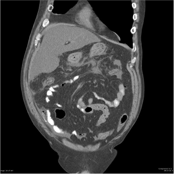 File:Acute pancreatitis (Radiopaedia 19135-19116 Coronal non-contrast 8).jpg