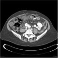 Acute pancreatitis (Radiopaedia 19136-19117 Axial C+ portal venous phase 28).jpg