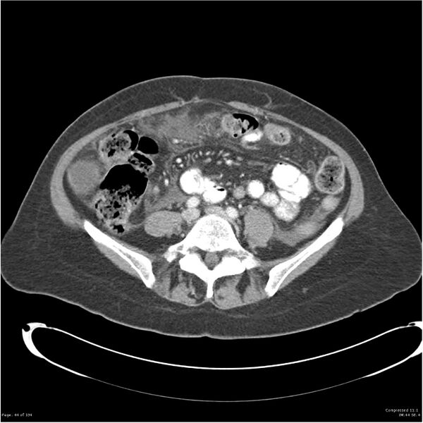 File:Acute pancreatitis (Radiopaedia 19136-19117 Axial C+ portal venous phase 28).jpg