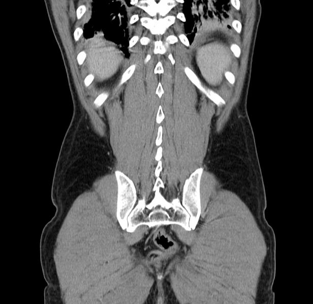 File:Acute pancreatitis (Radiopaedia 22572-22596 Coronal C+ portal venous phase 46).jpg