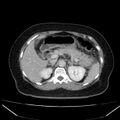 Acute pancreatitis - Balthazar C (Radiopaedia 26569-26714 Axial C+ portal venous phase 35).jpg