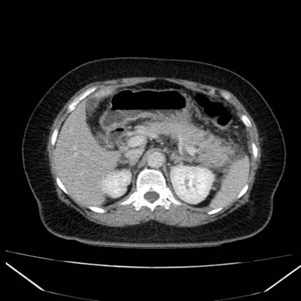 File:Acute pancreatitis - Balthazar C (Radiopaedia 26569-26714 Axial C+ portal venous phase 35).jpg