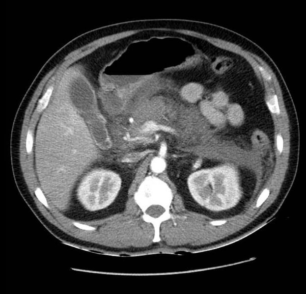 File:Acute pancreatitis - Balthazar E (Radiopaedia 23080-23110 Axial C+ arterial phase 23).jpg