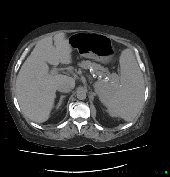 File:Acute renal failure post IV contrast injection- CT findings (Radiopaedia 47815-52557 Axial non-contrast 22).jpg