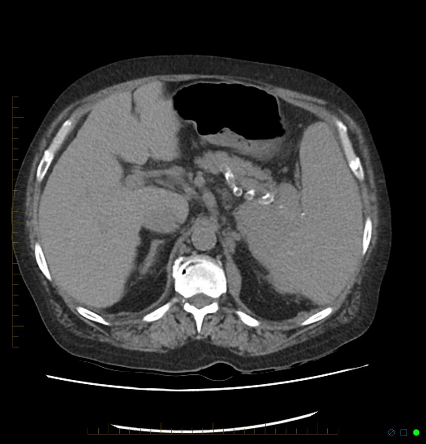 Acute renal failure post IV contrast injection- CT findings (Radiopaedia 47815-52557 Axial non-contrast 22).jpg