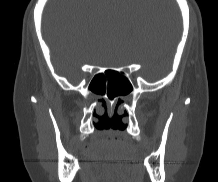 File:Acute sinusitis (Radiopaedia 22419-22455 Coronal bone window 27).jpg