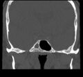 Acute sinusitis (Radiopaedia 23161-23215 Coronal bone window 53).jpg