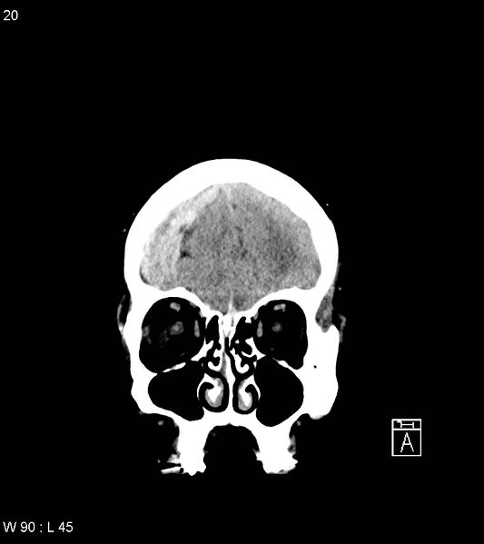File:Acute subdural hematoma with myelofibrosis (Radiopaedia 52582-58494 Coronal non-contrast 11).jpg