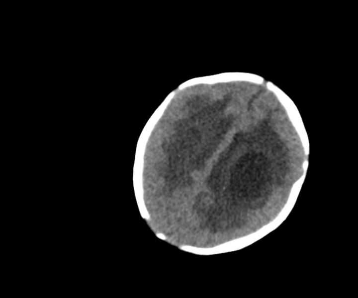 File:Acute ventriculitis (Radiopaedia 57502-64459 Axial non-contrast 16).jpg
