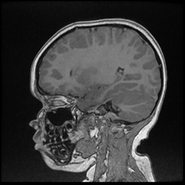 File:Adamantinomatous craniopharyngioma (Radiopaedia 77407-89529 Sagittal T1 C+ 48).jpg