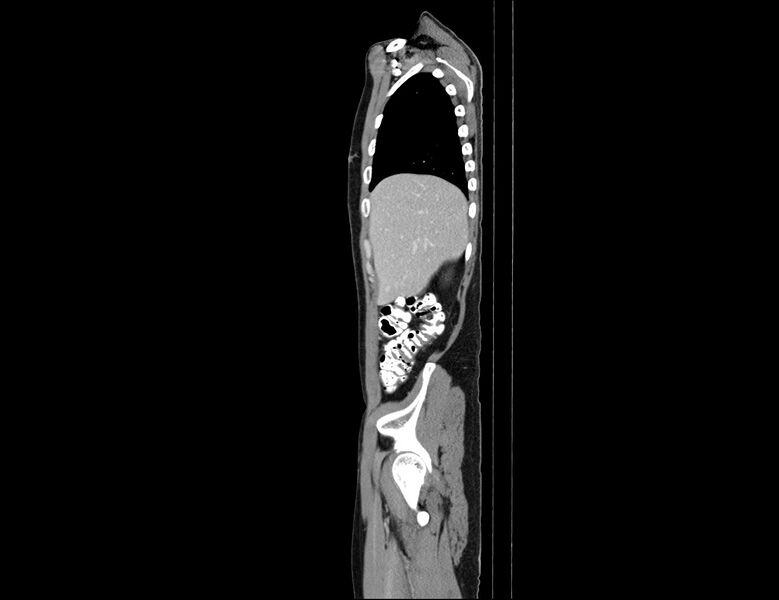 File:Addison disease (Radiopaedia 49318-54412 Sagittal C+ portal venous phase 57).jpg