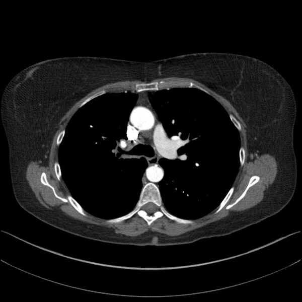 File:Adenocarcinoma of the lung (Radiopaedia 44205-47803 Axial C+ portal venous phase 34).jpg
