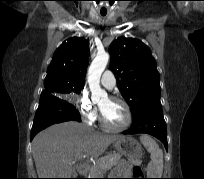 File:Adenocarcinoma of the lung (Radiopaedia 44205-47803 Coronal C+ portal venous phase 32).jpg