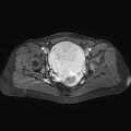 Adenomyoma of the uterus (huge) (Radiopaedia 9870-10438 Axial T1 C+ fat sat 13).jpg