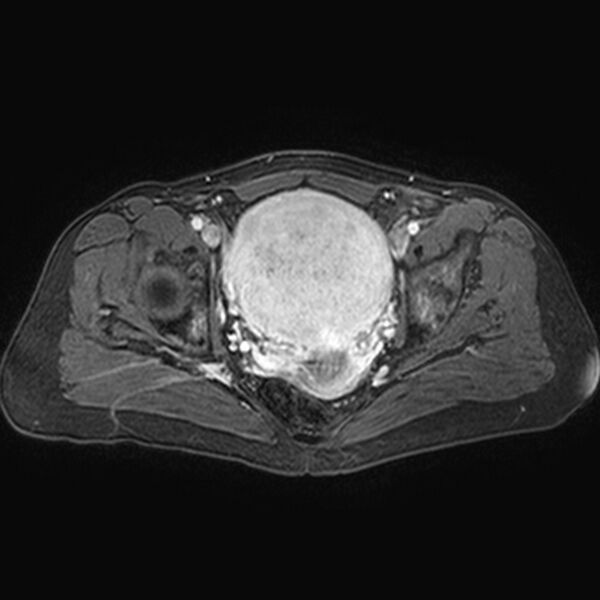 File:Adenomyoma of the uterus (huge) (Radiopaedia 9870-10438 Axial T1 C+ fat sat 13).jpg
