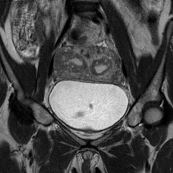 File:Adenomyosis within a septate uterus (Radiopaedia 69963-79981 Coronal T2 10).jpg