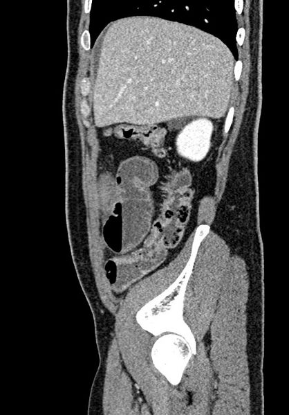 File:Adhesional small bowel obstruction (Radiopaedia 58900-66131 Sagittal C+ portal venous phase 52).jpg