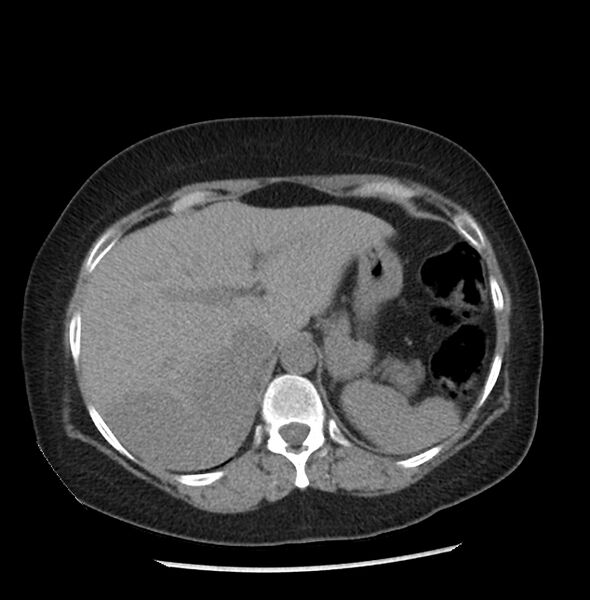 File:Adrenal cortical carcinoma with IVC invasion and thrombosis (Radiopaedia 34307-35597 Axial non-contrast 9).jpg
