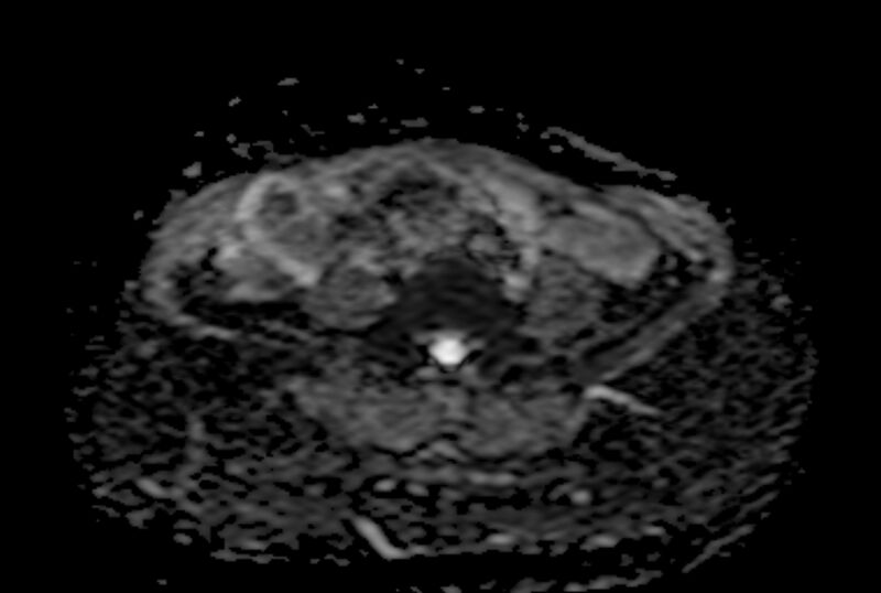 File:Adult granulosa cell tumor of the ovary (Radiopaedia 71581-81950 Axial ADC 3).jpg