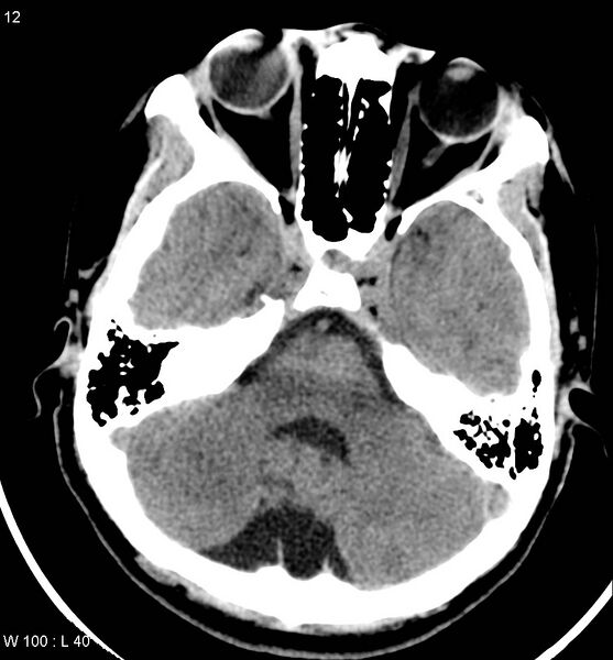 File:Aicardi syndrome (Radiopaedia 5353-7116 Axial non-contrast 9).jpg
